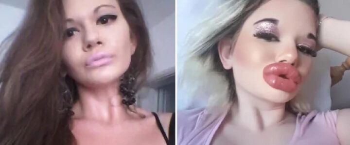 27 INIEZIONI ALLE LABBRA E RITOCCHINI AL VISO, SI CHIAMA ANDREA ED È LA DONNA CON LE LABBRA PIÙ GRANDI DEL MONDO