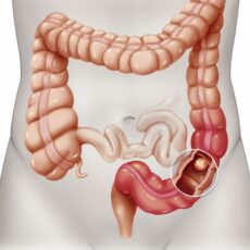 Ecco i sintomi del tumore al colon che state ignorando. Meglio fare attenzione!